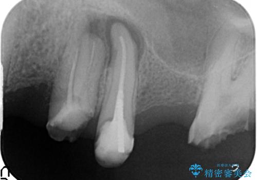 オールセラミッククラウン ブリッジによる欠損歯の補綴の治療前