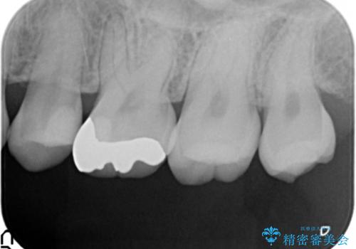 セラミックインレーとゴールドインレーの治療後