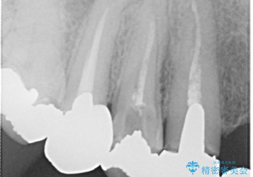 オールセラミッククラウン ブリッジによる欠損歯の補綴の治療前