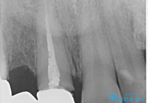 オールセラミッククラウン ブリッジによる欠損歯の補綴の治療前