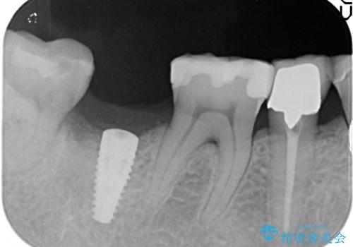 右下の奥歯を抜歯　インプラント治療による咬合回復の治療中