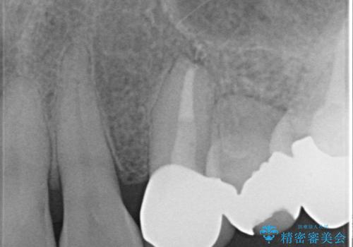オールセラミッククラウン 再根管治療後の補綴の治療後