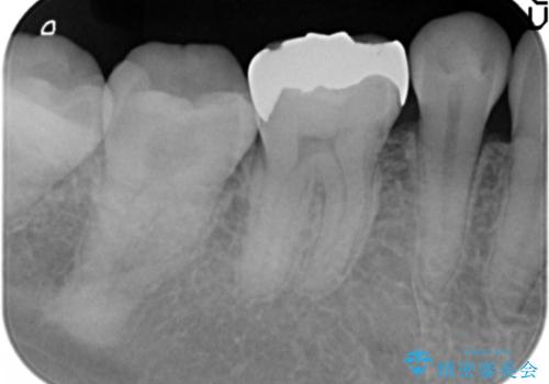 目立つ銀歯を白くしたいの治療前