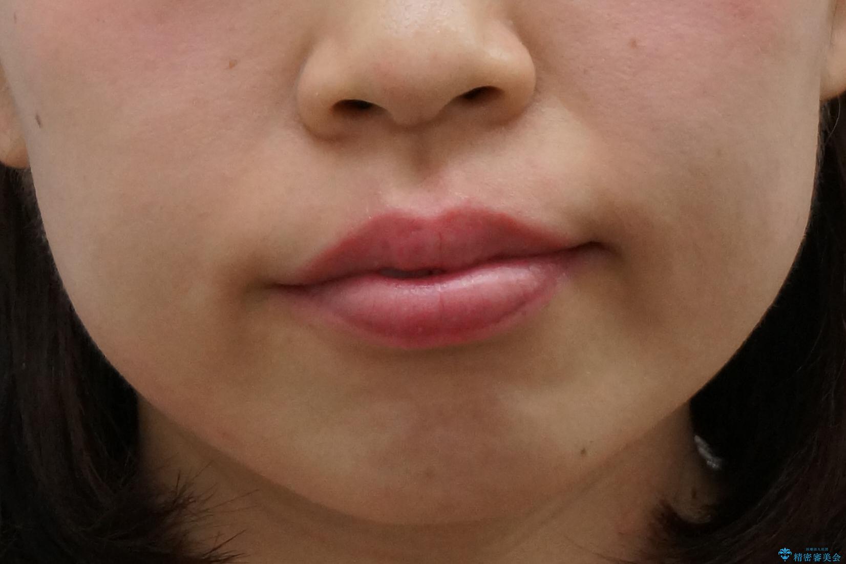 前歯のがたつき インビザラインでの治療前(顔貌)