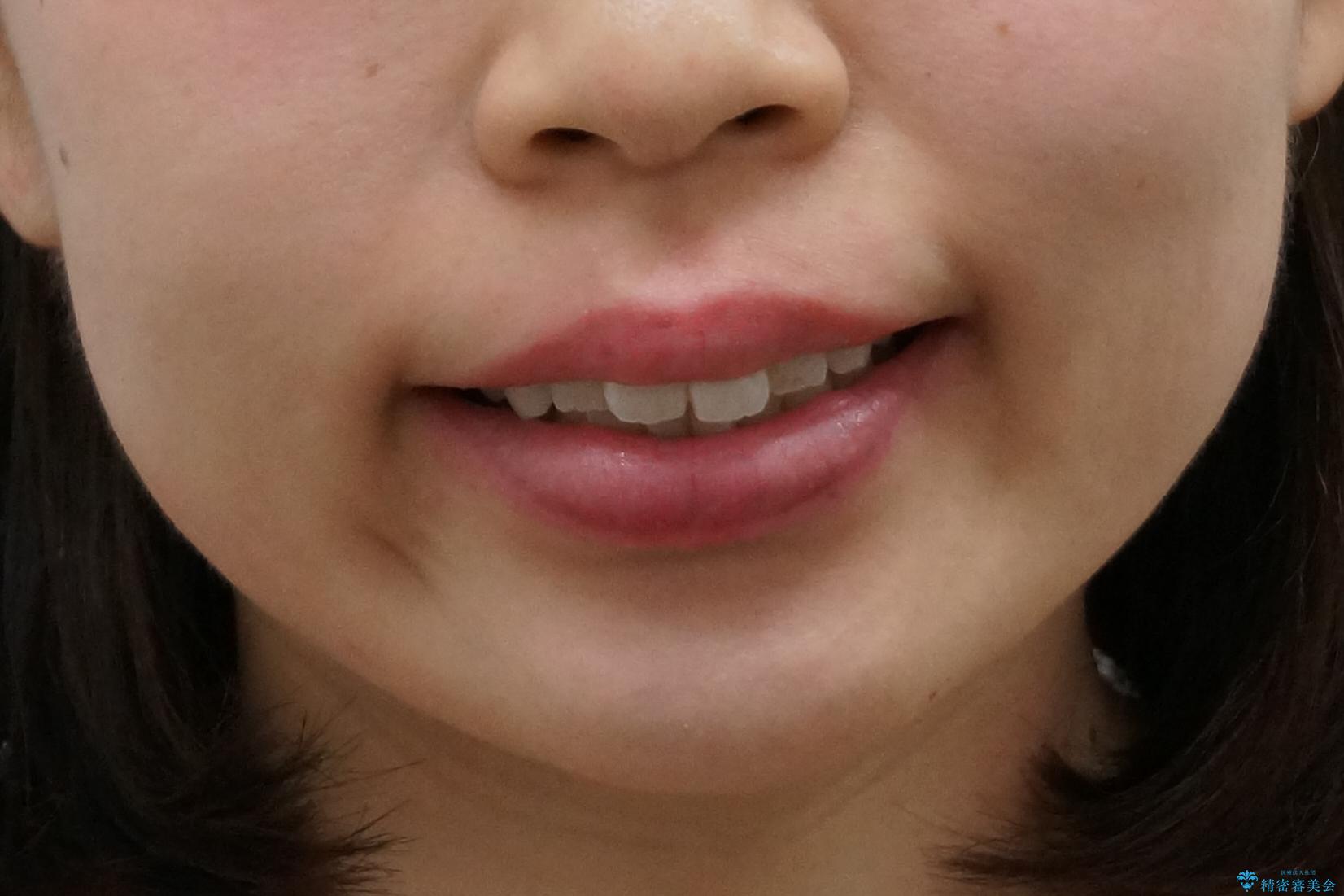 前歯のがたつき インビザラインでの治療前(顔貌)