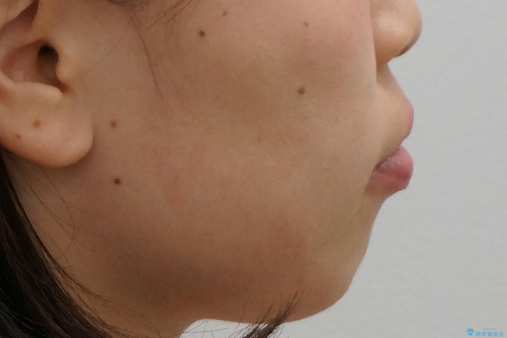 前歯のがたつき インビザラインでの治療前(顔貌)