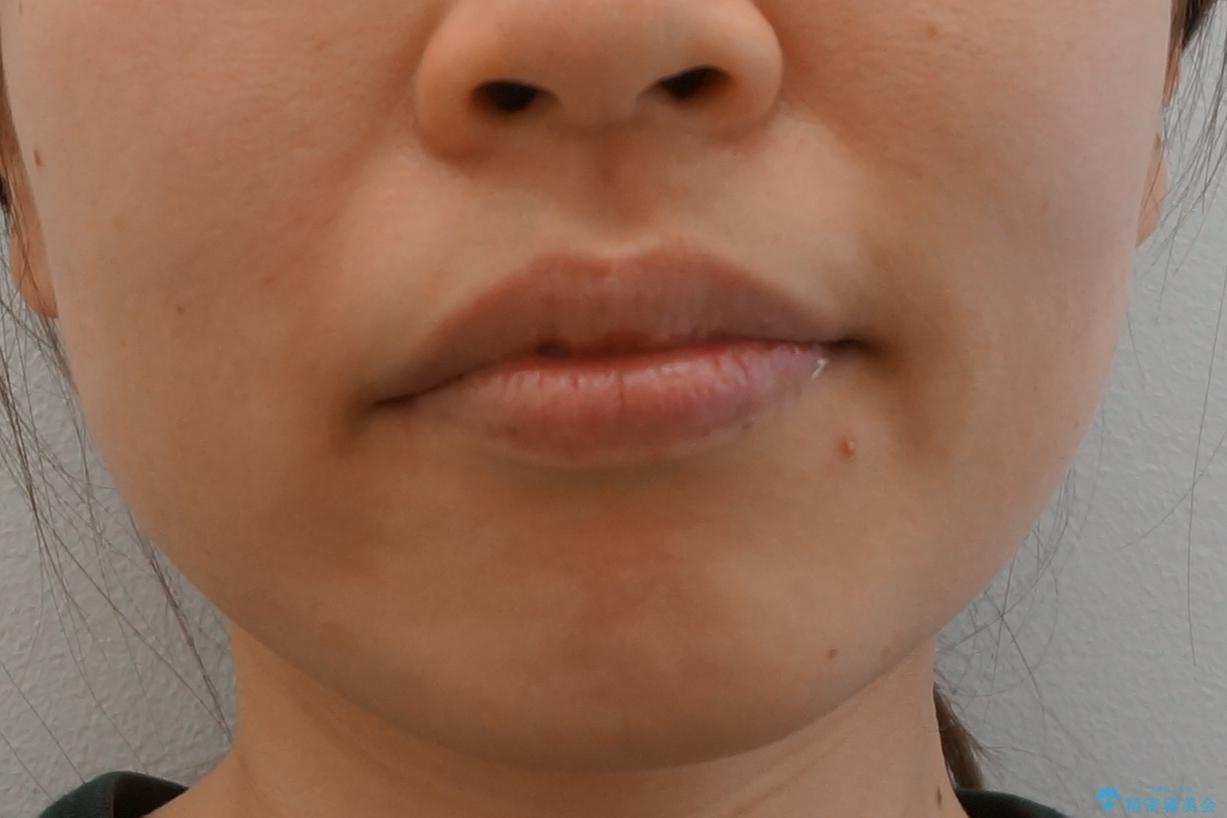 前歯のがたつき インビザラインでの治療後(顔貌)