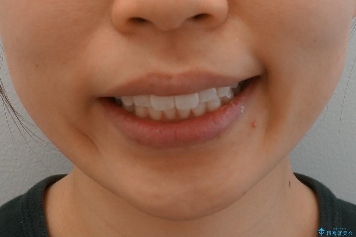前歯のがたつき　インビザラインでの治療後（顔貌）