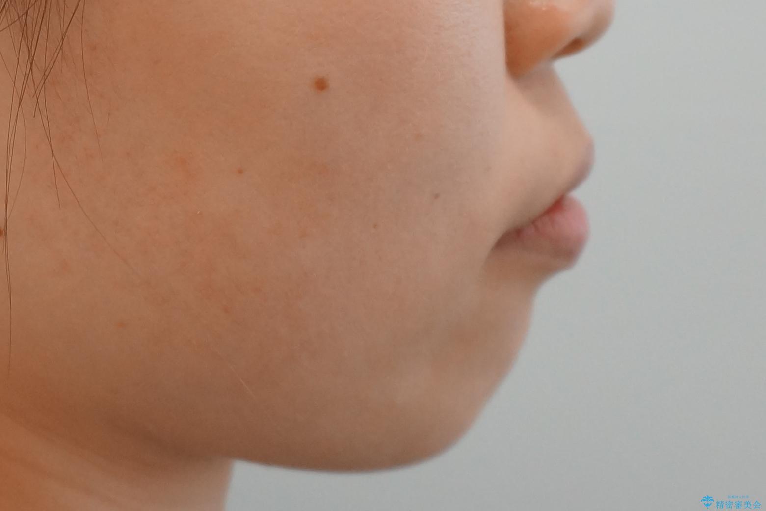 前歯のがたつき インビザラインでの治療後(顔貌)