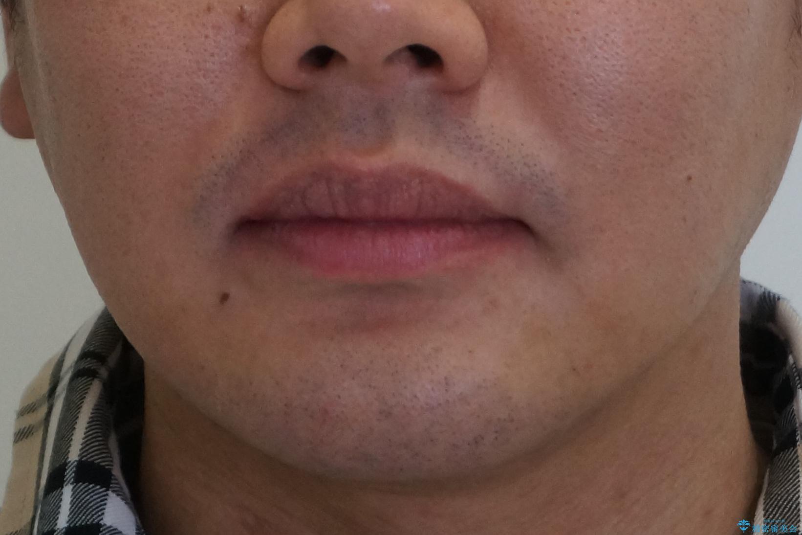 すきっ歯・出っ歯 コンプレックスの前歯を治したい 目立たない方法で セラミック治療は不可能な症例の治療後(顔貌)