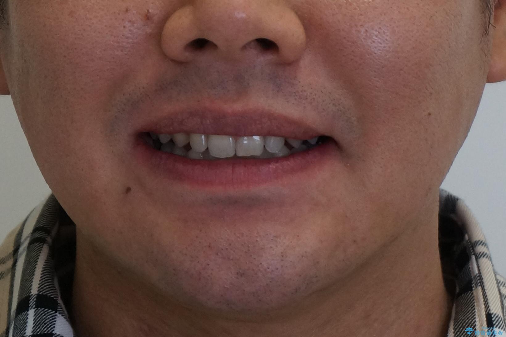 すきっ歯・出っ歯　コンプレックスの前歯を治したい　目立たない方法で　セラミック治療は不可能な症例の治療後（顔貌）