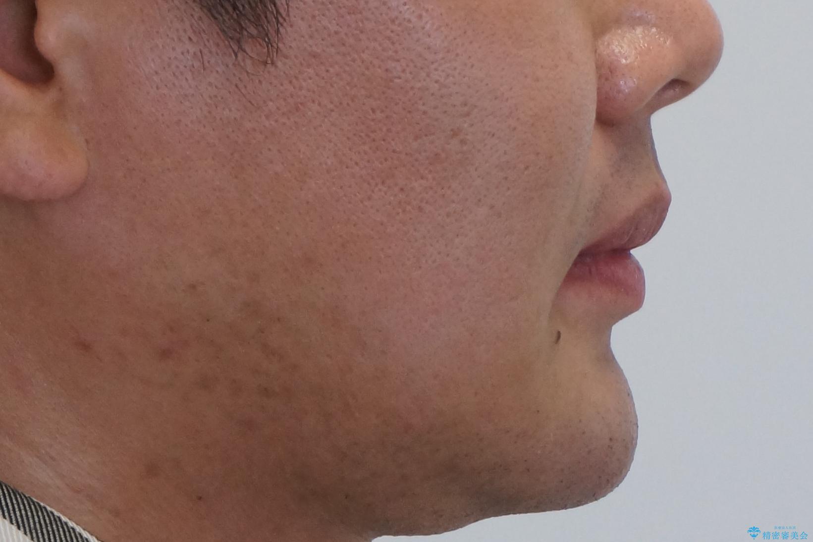 すきっ歯・出っ歯 コンプレックスの前歯を治したい 目立たない方法で セラミック治療は不可能な症例の治療後(顔貌)