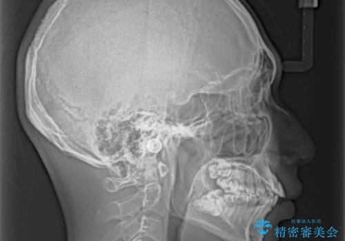 前歯の叢生を解消 ワイヤー装置での抜歯矯正の治療前