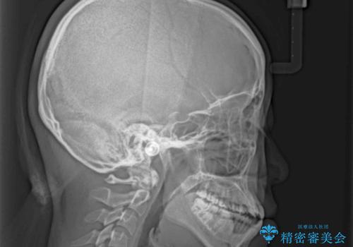 外科矯正は受けたくない 上顎骨拡大による妥協的な受け口治療の治療前