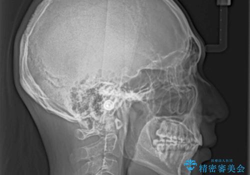 前歯の叢生を解消 ワイヤー装置での抜歯矯正の治療後