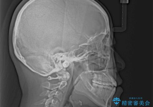 外科矯正は受けたくない 上顎骨拡大による妥協的な受け口治療の治療後