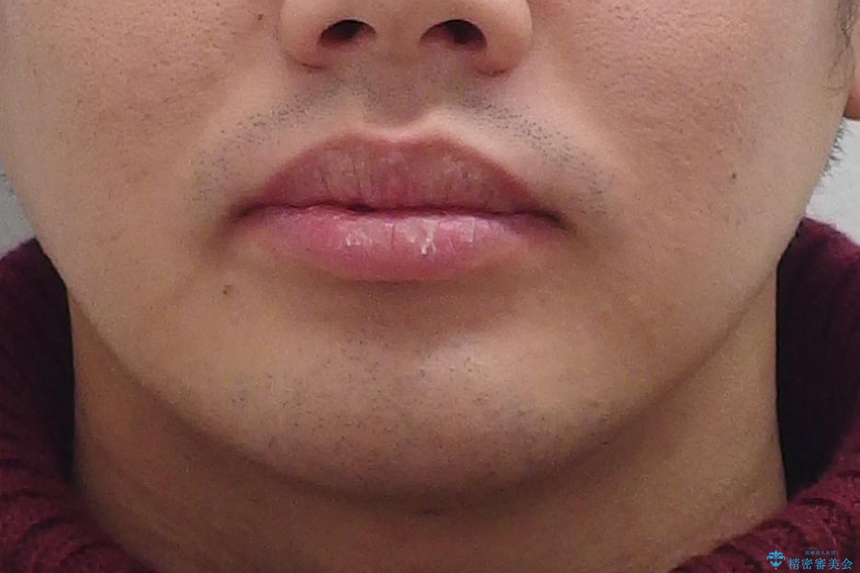 すきっ歯・出っ歯 コンプレックスの前歯を治したい 目立たない方法で セラミック治療は不可能な症例の治療前(顔貌)