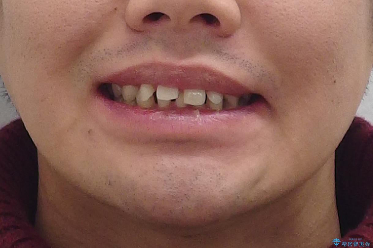 下の前歯のインプラント　生まれつき歯が少ないの治療前（顔貌）