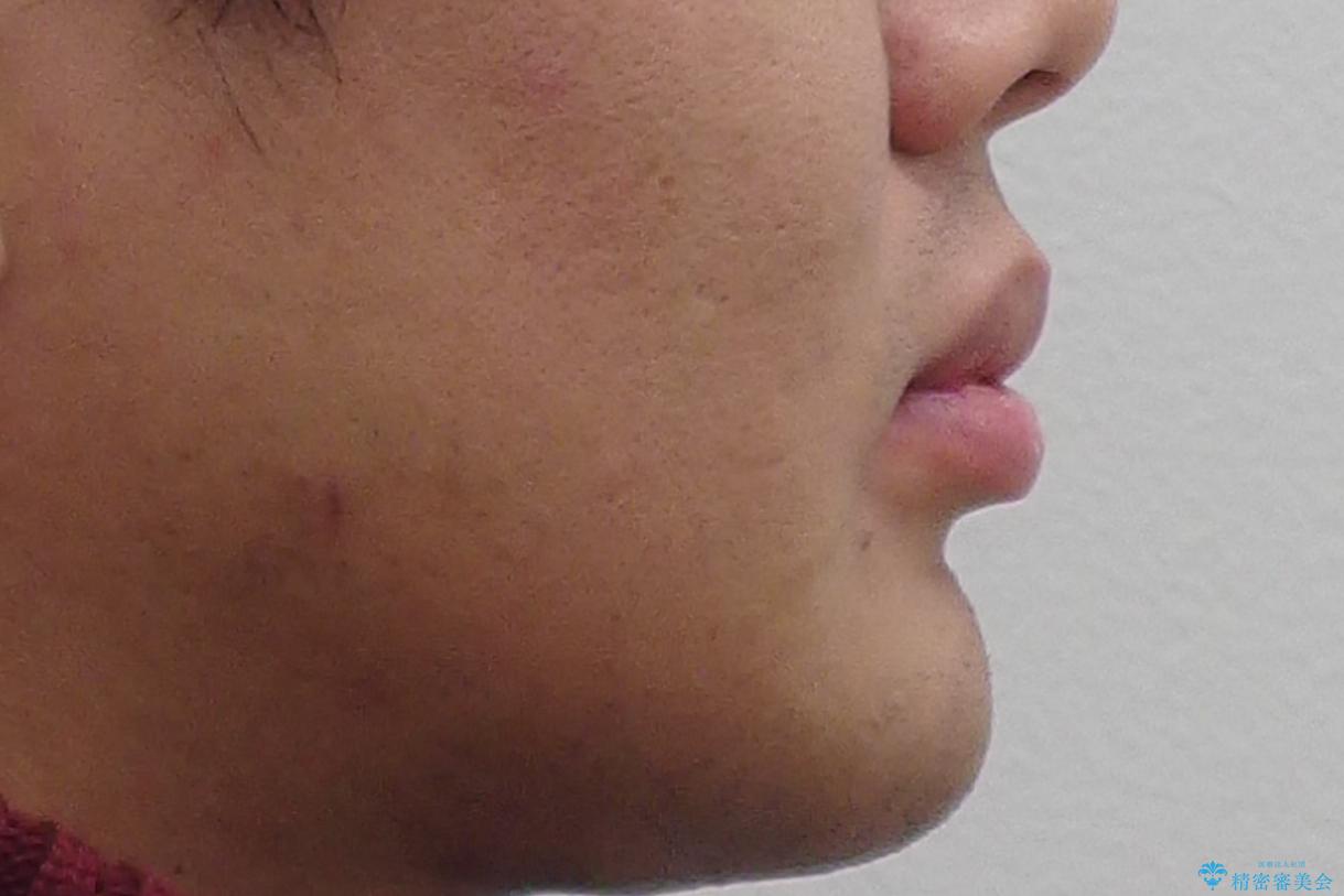 すきっ歯・出っ歯 コンプレックスの前歯を治したい 目立たない方法で セラミック治療は不可能な症例の治療前(顔貌)