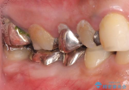 オールセラミッククラウン ブリッジによる欠損歯の補綴の治療前