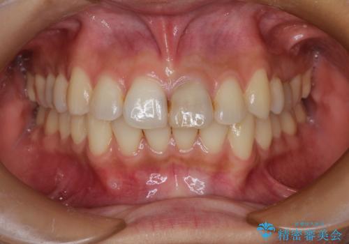 口元が出てるのが気になる 抜歯矯正でしっかりと前歯をさげてすっきりした口元への治療前