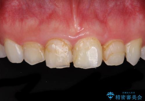 気になる前歯を美しく マウスピース矯正とセラミッククラウンの治療中