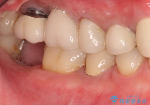 右下の奥歯を抜歯　インプラント治療による咬合回復