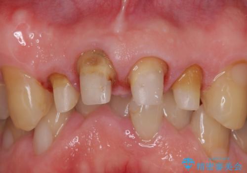 オールセラミッククラウン セラミックで前歯の見た目を改善の治療中