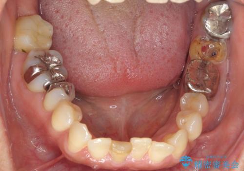 インプラントは嫌 親知らずの移植 50代女性の治療前
