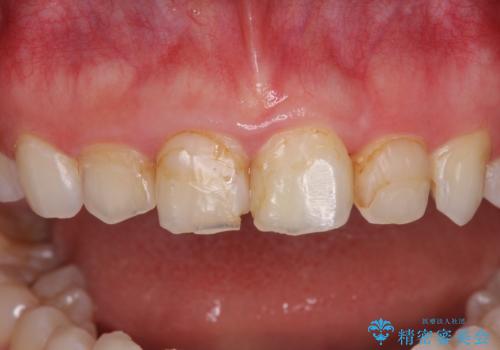 気になる前歯を美しく マウスピース矯正とセラミッククラウンの治療中