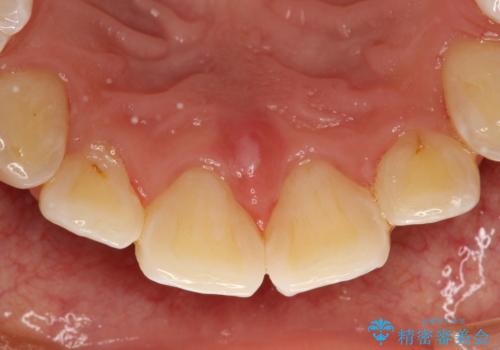 歯科医院で初めてのクリーニング PMTC30分コースの治療後
