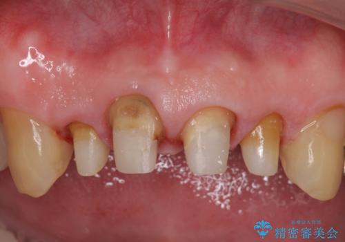 オールセラミッククラウン セラミックで前歯の見た目を改善の治療中