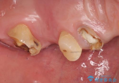 オールセラミッククラウン ブリッジによる欠損歯の補綴の治療前