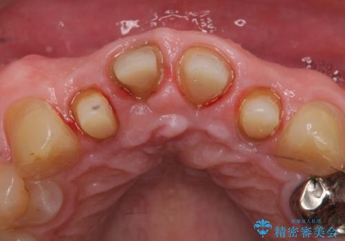 オールセラミッククラウン セラミックで前歯の見た目を改善の治療中