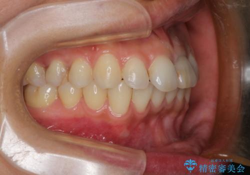 口元が出てるのが気になる 抜歯矯正でしっかりと前歯をさげてすっきりした口元への治療前