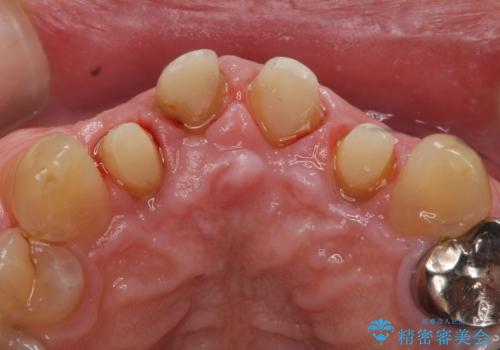 オールセラミッククラウン セラミックで前歯の見た目を改善の治療中