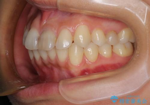 口元が出てるのが気になる 抜歯矯正でしっかりと前歯をさげてすっきりした口元への治療前