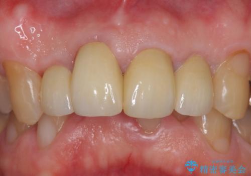 オールセラミッククラウン セラミックで前歯の見た目を改善の治療後