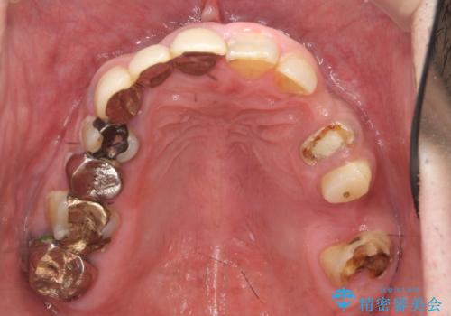オールセラミッククラウン　ブリッジによる欠損歯の補綴の症例 治療前