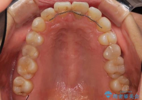 口元が出てるのが気になる 抜歯矯正でしっかりと前歯をさげてすっきりした口元への治療前