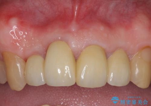 オールセラミッククラウン セラミックで前歯の見た目を改善の症例 治療後