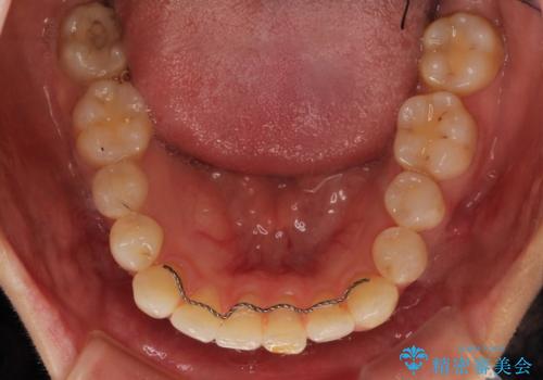 口元が出てるのが気になる 抜歯矯正でしっかりと前歯をさげてすっきりした口元への治療前