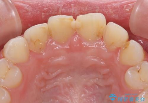 気になる前歯を美しく マウスピース矯正とセラミッククラウンの治療中