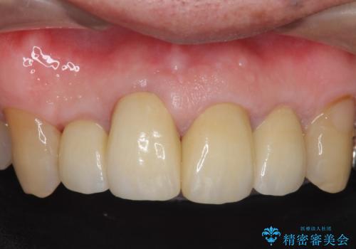 オールセラミッククラウン セラミックで前歯の見た目を改善の治療後