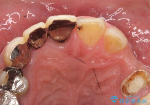 オールセラミッククラウン ブリッジによる欠損歯の補綴の治療前