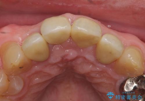 オールセラミッククラウン セラミックで前歯の見た目を改善の治療後