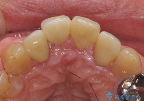 オールセラミッククラウン セラミックで前歯の見た目を改善の治療後