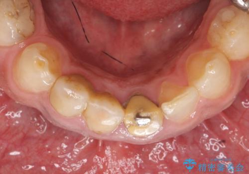 オールセラミッククラウン ブリッジによる欠損歯の補綴の治療前