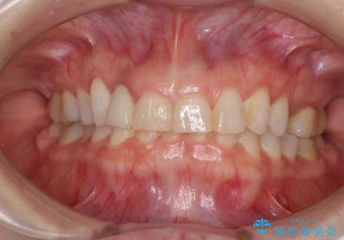 歯肉が腫れている前歯　外科処置を併用したオールセラミッククラウンの治療前