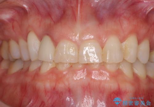 歯肉が腫れている前歯 外科処置を併用したオールセラミッククラウンの治療前
